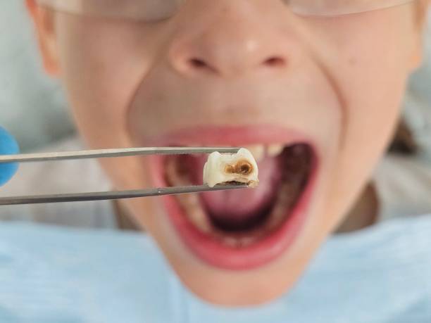 Best Emergency Dental Care for Broken or Chipped Teeth in Emerson, GA